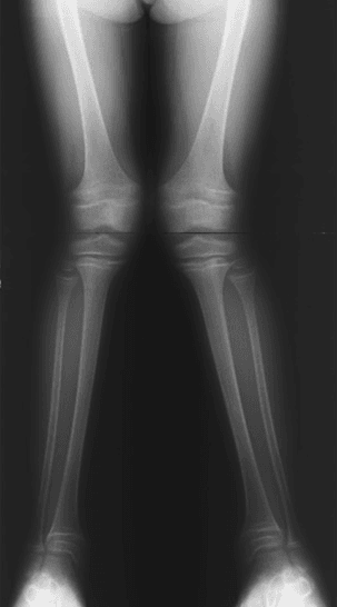 Standing AP radiograph of both lower limbs showing marked bilateral genu valgum with widened irregular metaphyses at the knees