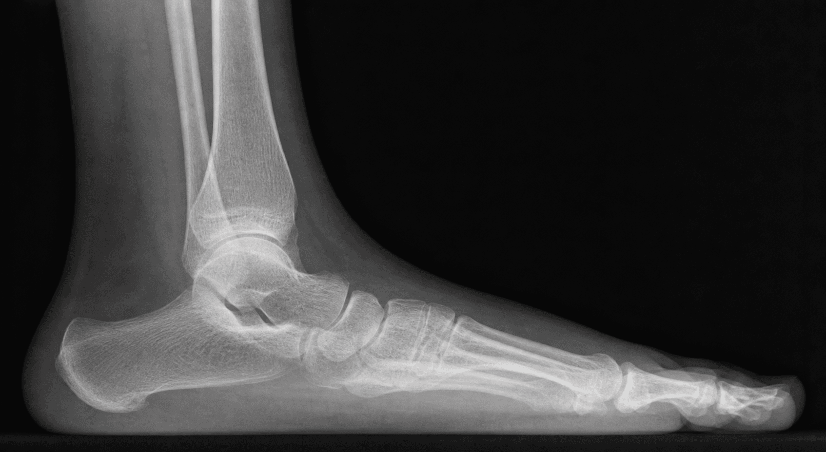 Weight-bearing lateral radiograph of the foot, the first-line view for assessing flatfoot.