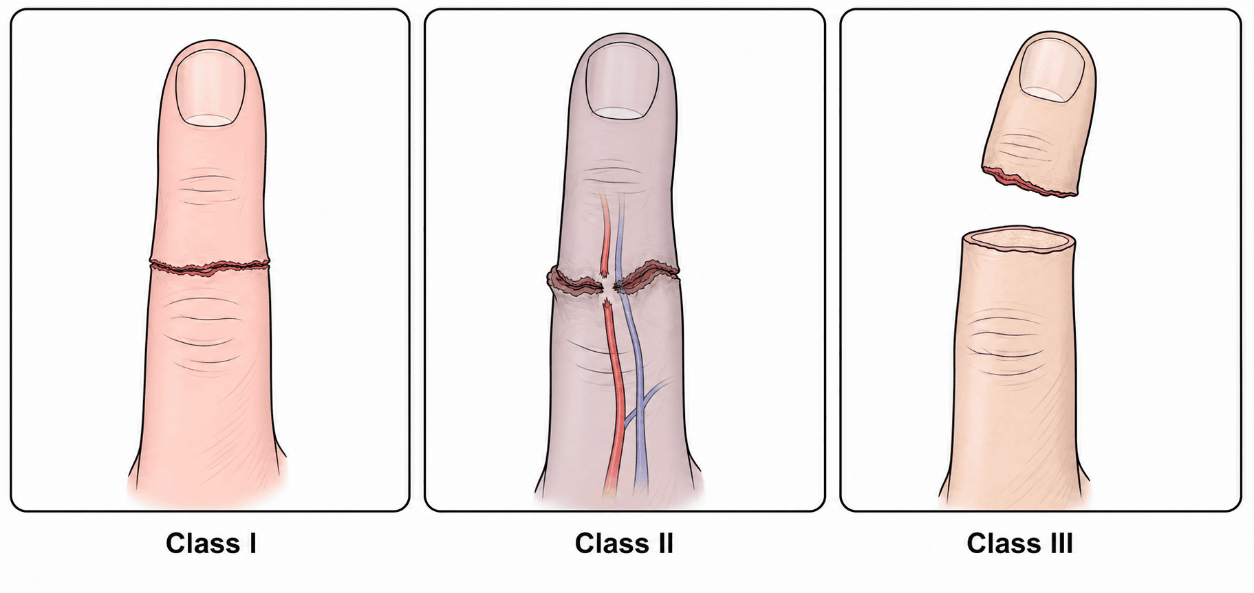 Three-panel diagram of the Urbaniak classification of ring avulsion injuries: class I intact circulation, class II inadequate circulation with torn vessels, class III complete degloving or amputation