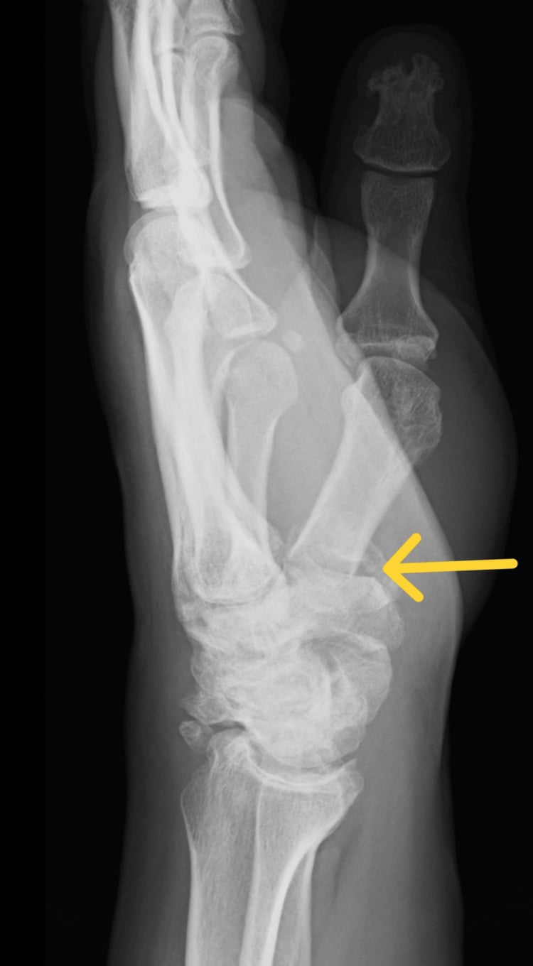 Lateral thumb radiograph showing a Rolando fracture and first CMC joint subluxation