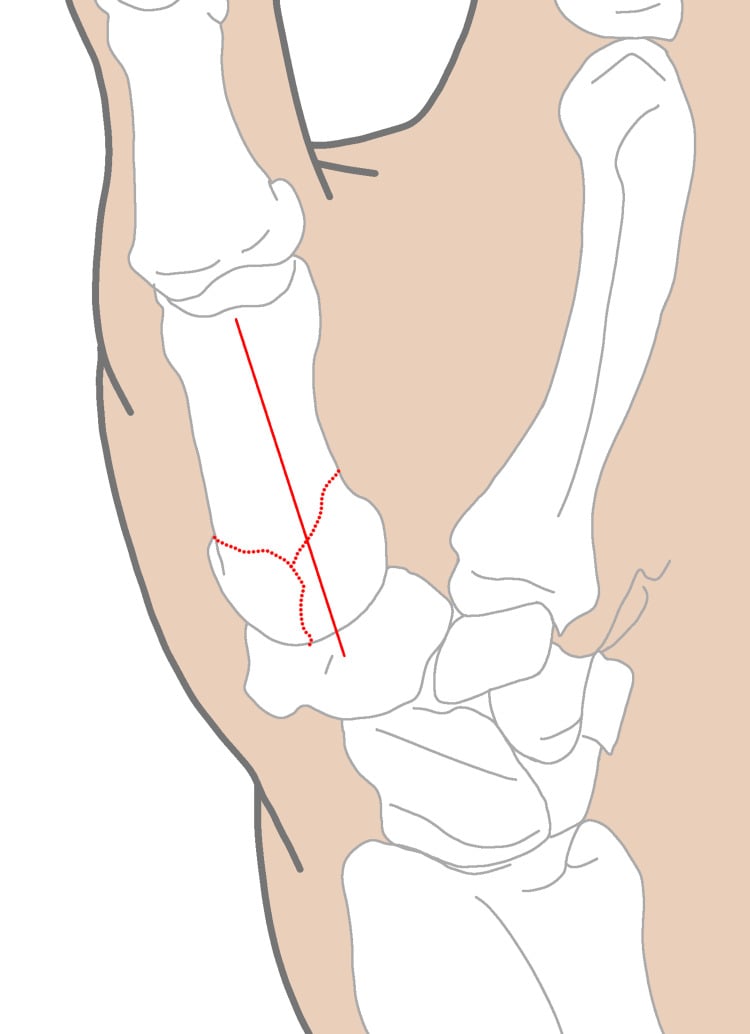 Dorsal skin incision and capsulotomy planning for a Y-shaped Rolando fracture