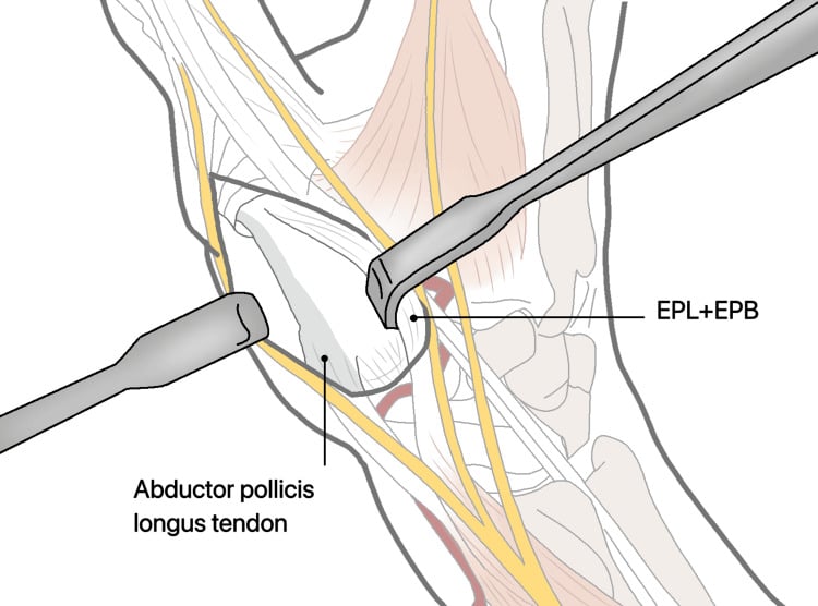 Dorsal thumb exposure with EPL and EPB retracted ulnarly and APL identified radially