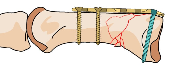 Illustration of Rolando fracture plate length and distal shaft screw fixation