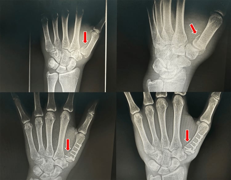 Preoperative and postoperative radiographs of a Rolando fracture treated with a locking plate