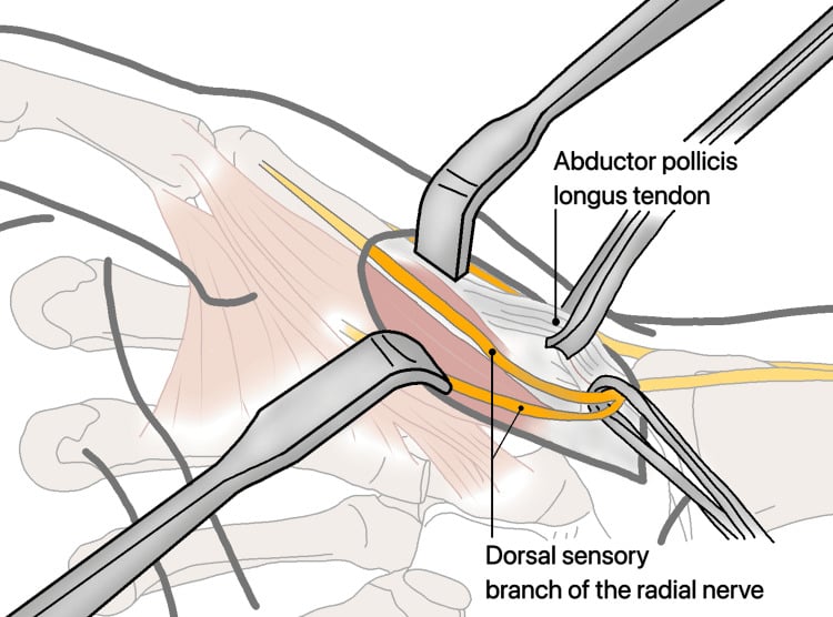 Dorsal thumb dissection showing the superficial radial nerve branch crossing beside the APL tendon