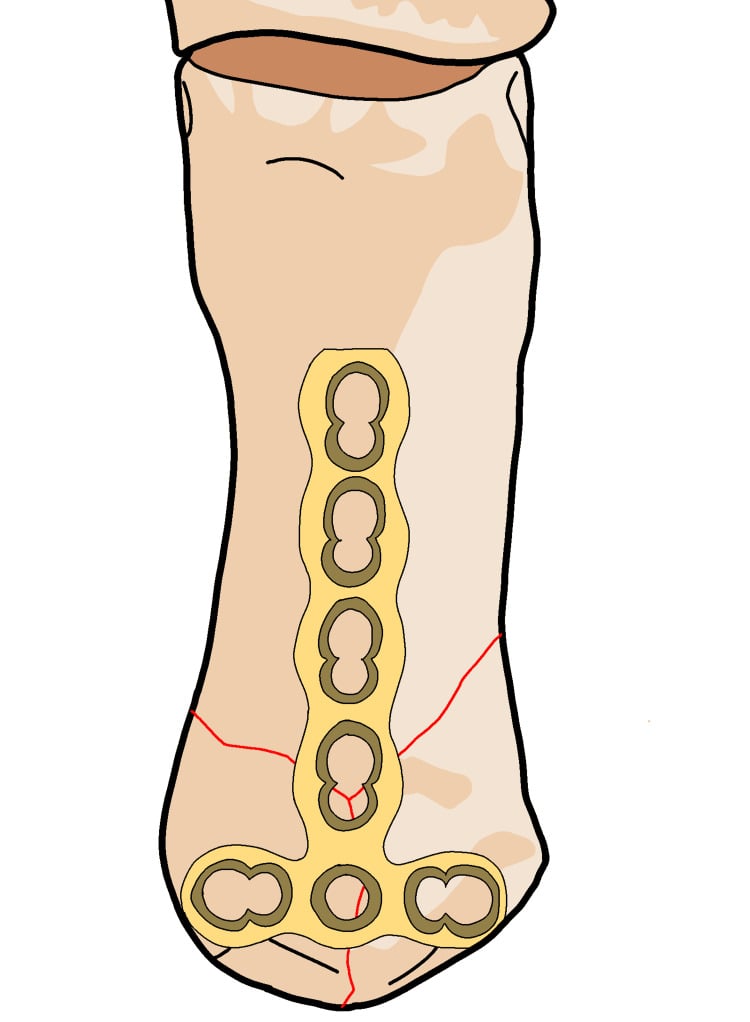 Illustration of a contoured T-shaped locking plate spanning a Rolando fracture