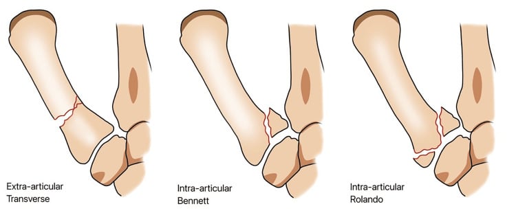 Illustrated comparison of extra-articular, Bennett and Rolando fractures at the thumb metacarpal base