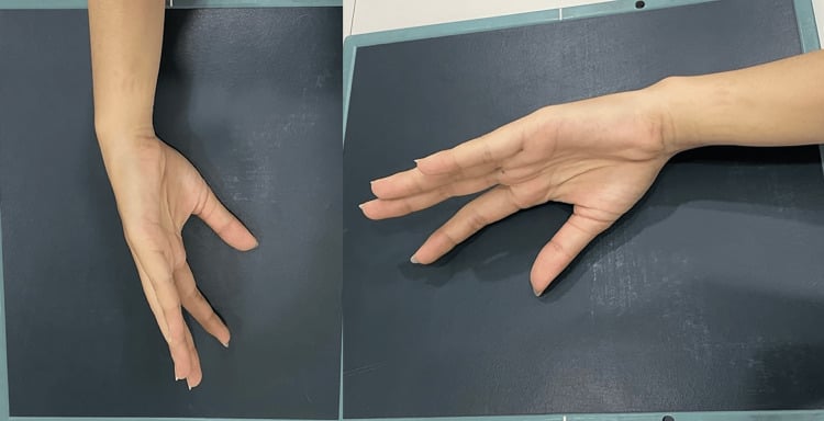 Hand positioning for a true lateral radiographic projection of the thumb