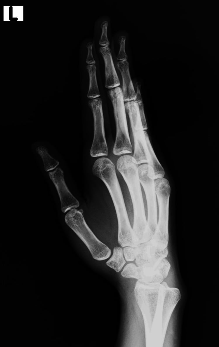 True lateral thumb radiograph obtained with the dedicated positioning technique
