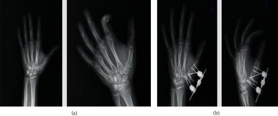 Preoperative and postoperative radiographs of a Rolando fracture treated with a dynamic external fixator