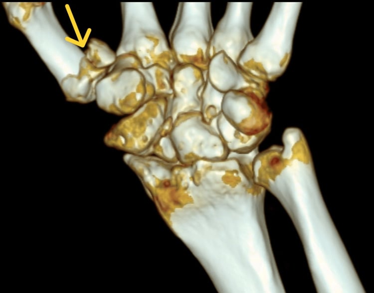 3D CT reconstruction showing comminuted Rolando fracture morphology