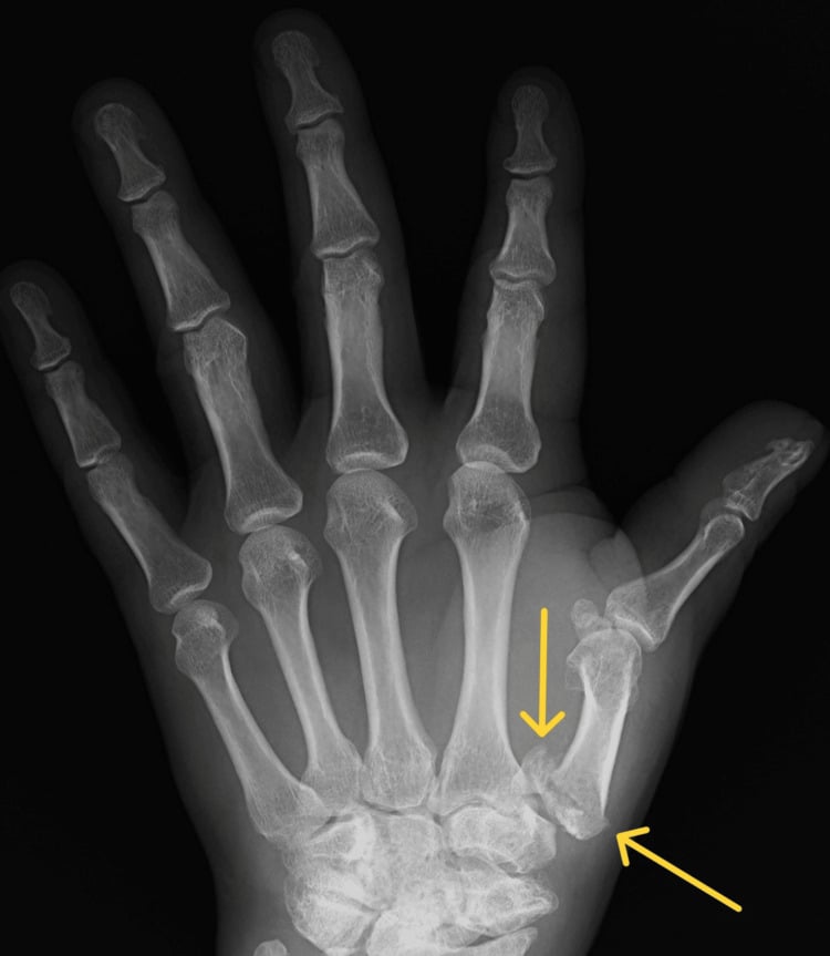 AP hand radiograph showing Rolando fracture with CMC subluxation