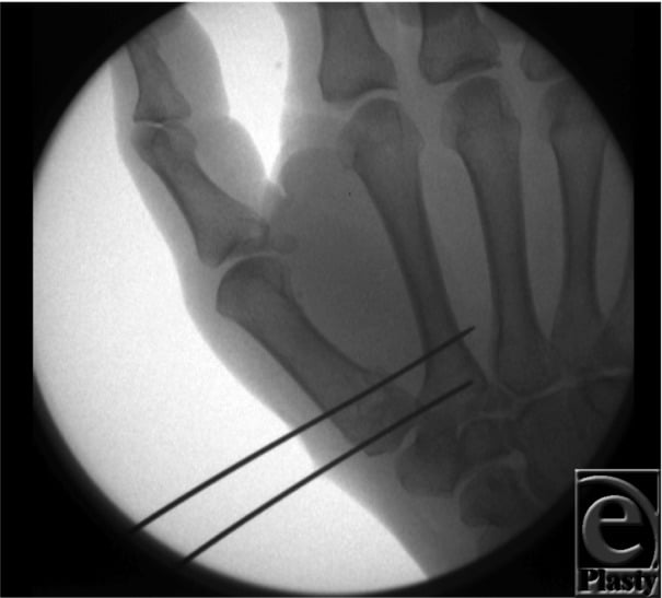 Intraoperative fluoroscopic image of closed reduction and percutaneous K-wire fixation of a Rolando fracture