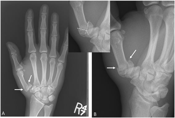 AP and oblique radiographs of a Rolando fracture with an inset tracing of the Y-shaped articular split