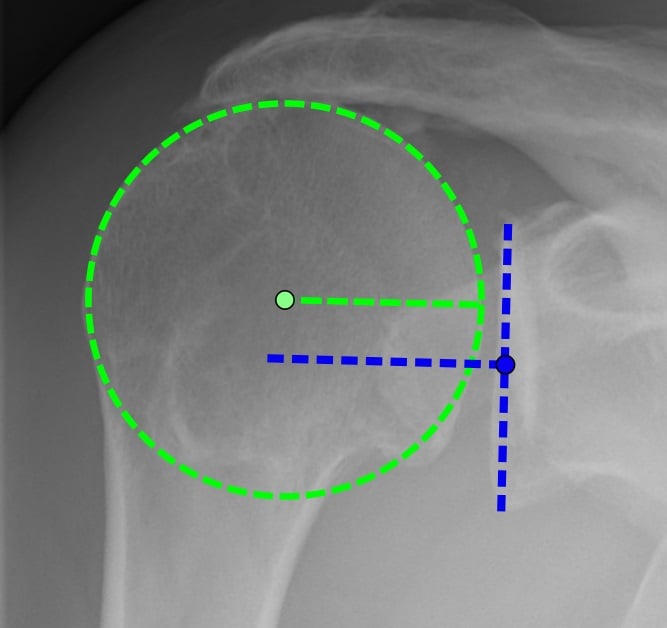 AP shoulder X-ray showing superior humeral migration in rotator cuff arthropathy