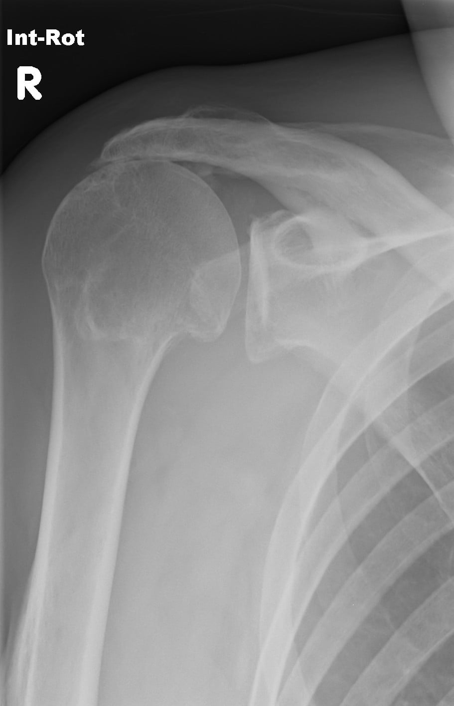 Right shoulder X-ray showing reduced acromiohumeral distance