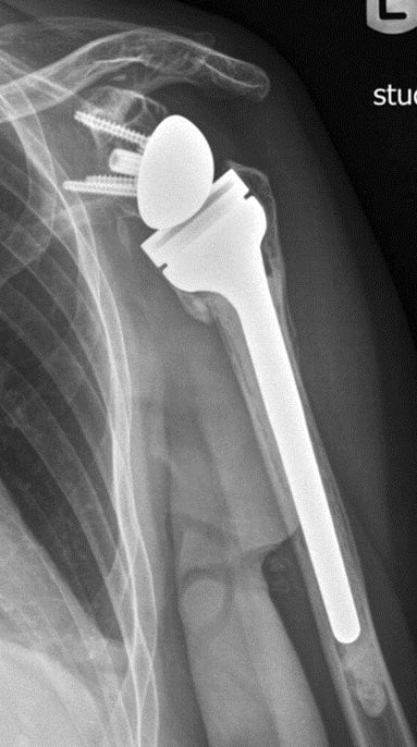 AP X-ray of reverse total shoulder arthroplasty