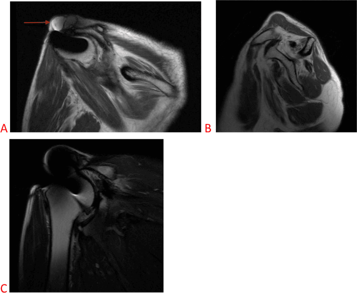 Coronal and sagittal MRI showing an acromioclavicular cyst, retracted massive cuff tear and severe fatty infiltration