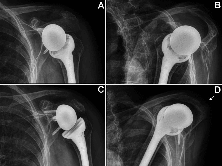 Serial AP and scapular Y radiographs showing an acromial stress fracture developing after reverse shoulder arthroplasty