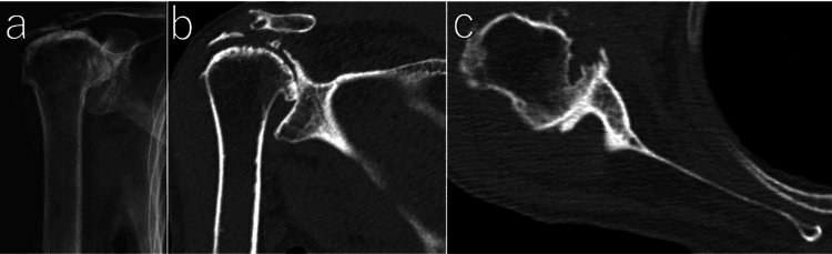 AP radiograph and multiplanar CT showing Hamada grade 5 cuff tear arthropathy with Favard E3 glenoid erosion