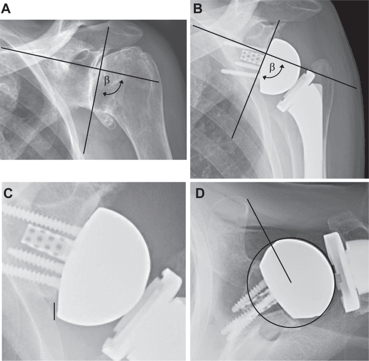 Shoulder radiographs demonstrating glenoid inclination, inferior offset and centre-of-rotation measurements