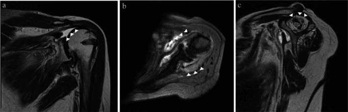 Multiplanar shoulder MRI showing a massive rotator cuff tear and Goutallier grade 4 fatty infiltration