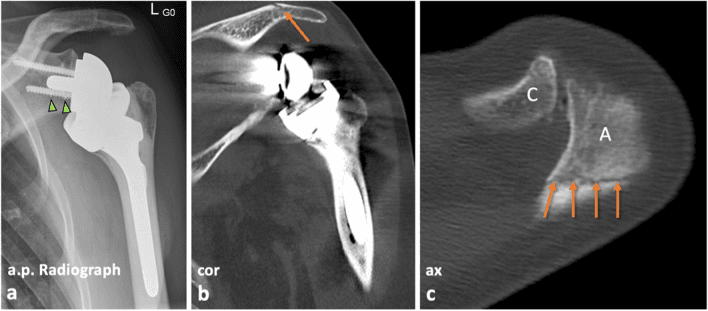 Radiograph and CT showing an occult acromial insufficiency fracture after reverse shoulder arthroplasty