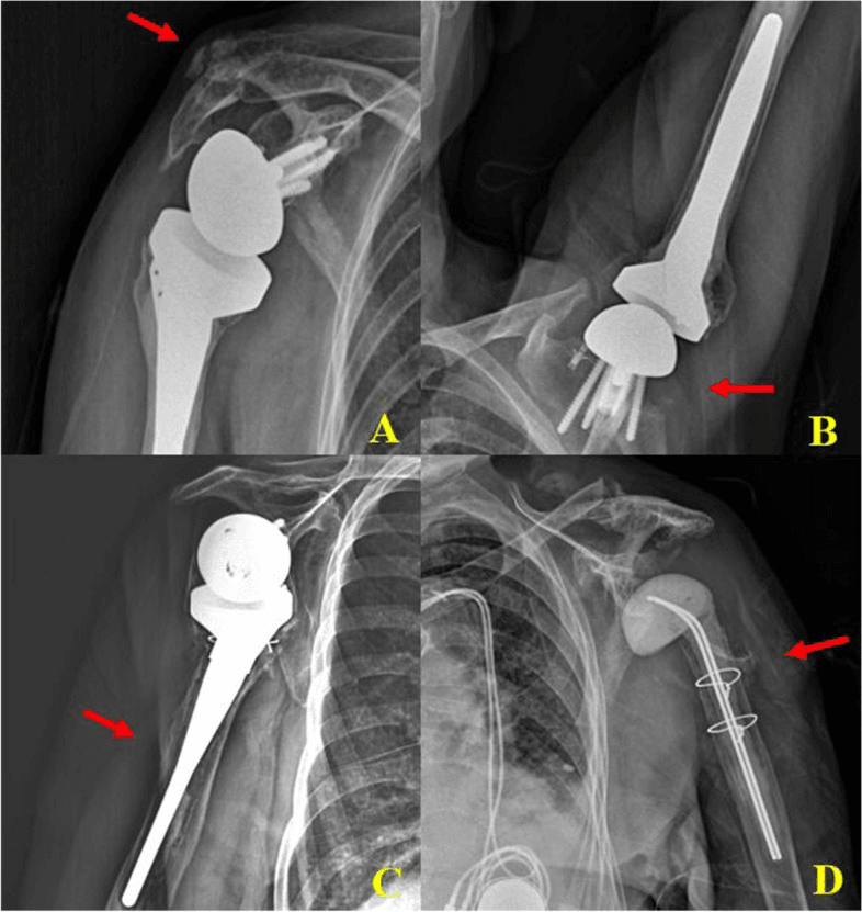 Radiographs showing acromial fracture, grade 4 scapular notching, humeral stem loosening and an antibiotic spacer after reverse shoulder arthroplasty