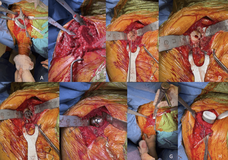 Eight-step intraoperative sequence of reverse total shoulder arthroplasty