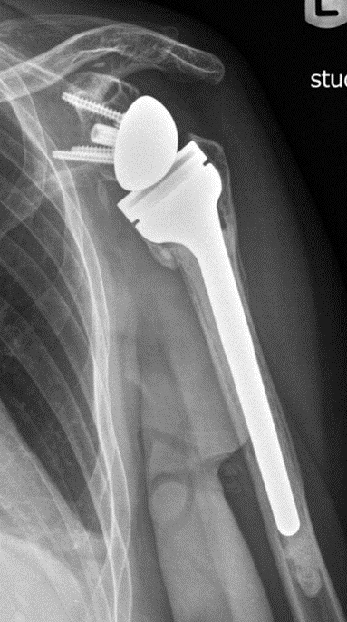 AP radiograph showing a reverse total shoulder arthroplasty