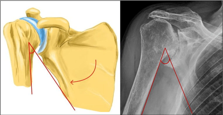 Illustration and AP radiograph showing a reduced scapulohumeral angle in cuff tear arthropathy