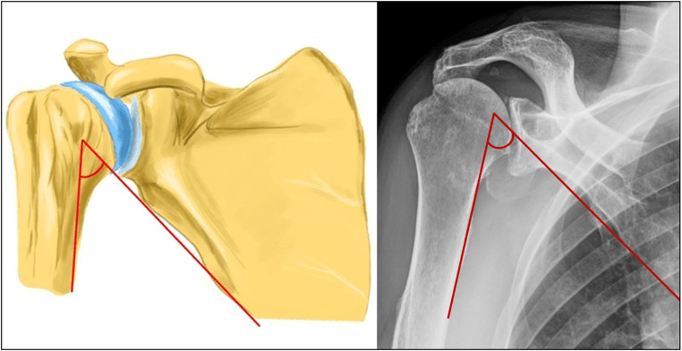 Illustration and AP radiograph showing the normal scapulohumeral angle