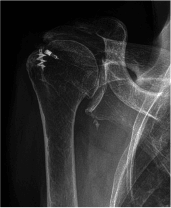 Grashey radiograph showing superior humeral migration, implants from a previous cuff repair and an acromioclavicular joint cyst in cuff tear arthropathy