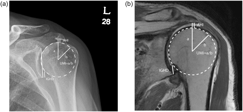 Radiographic and MRI measurements of superior humeral migration