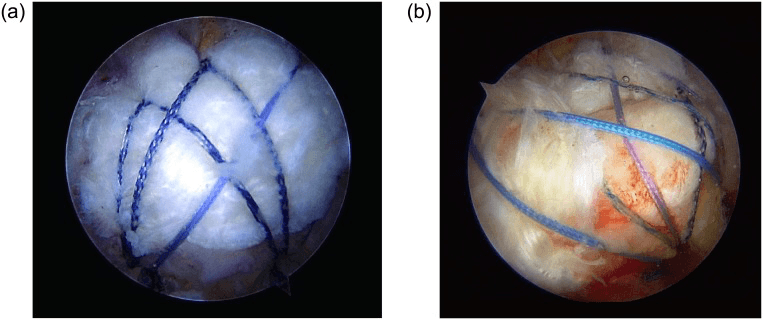 Arthroscopic complete and partial repair of massive rotator cuff tears