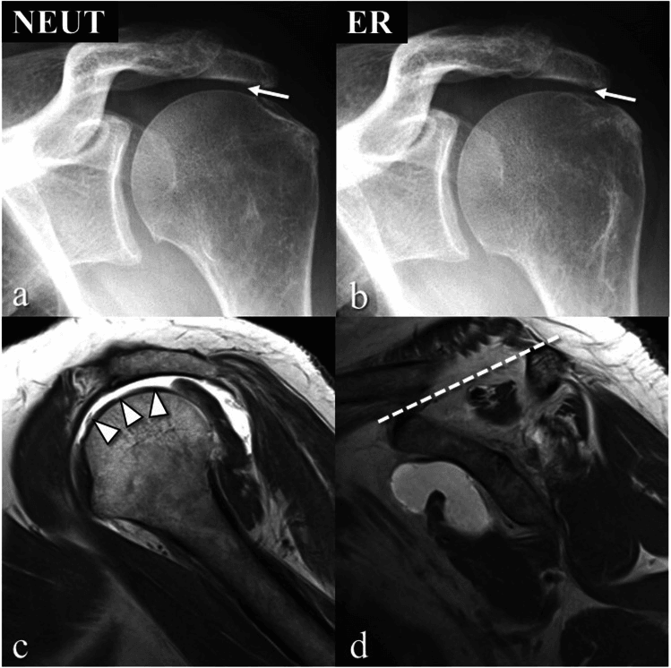 Radiograph and MRI showing massive cuff tear with superior humeral migration