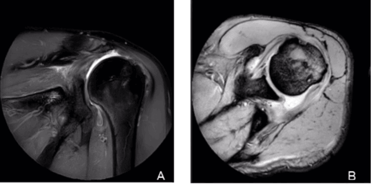 MRI showing supraspinatus retear with infraspinatus extension