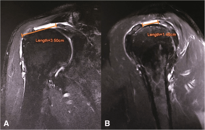 Two MRI panels with calliper measurements of rotator cuff tear length, 3.50cm and 1.46cm