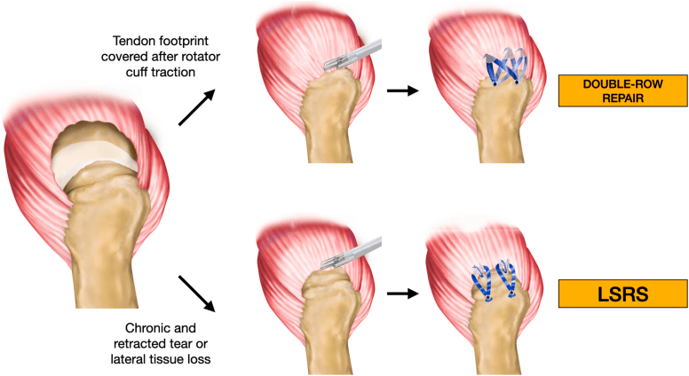 Decision between double-row and partial repair based on tendon mobility