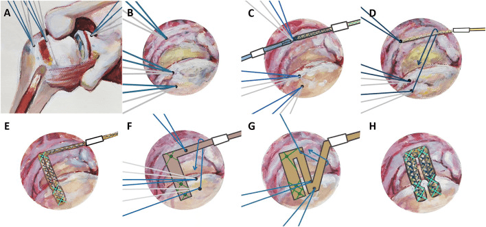 Superior capsular reconstruction anchor and graft configuration