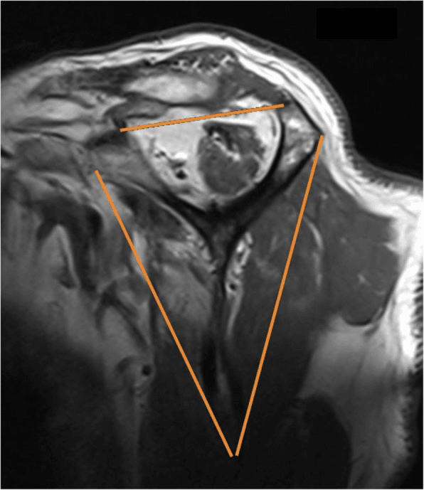 Sagittal MRI demonstrating the supraspinatus tangent sign