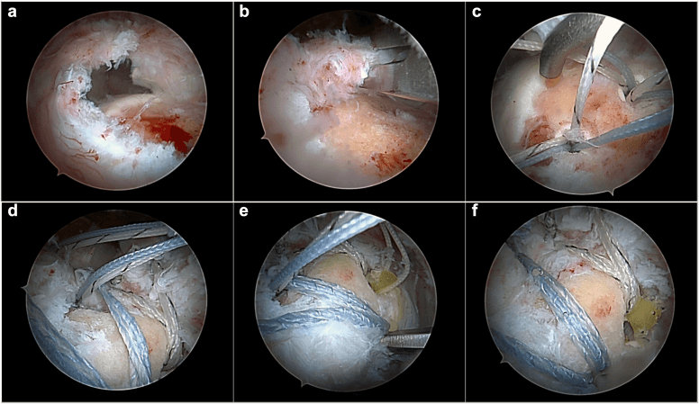Arthroscopic sequence for a retracted U-shaped massive cuff tear
