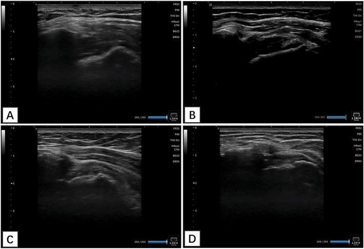 Postoperative ultrasound examples of intact and failed cuff repair