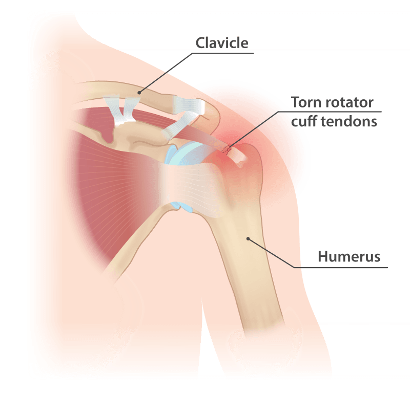Anatomical illustration of rotator cuff tear