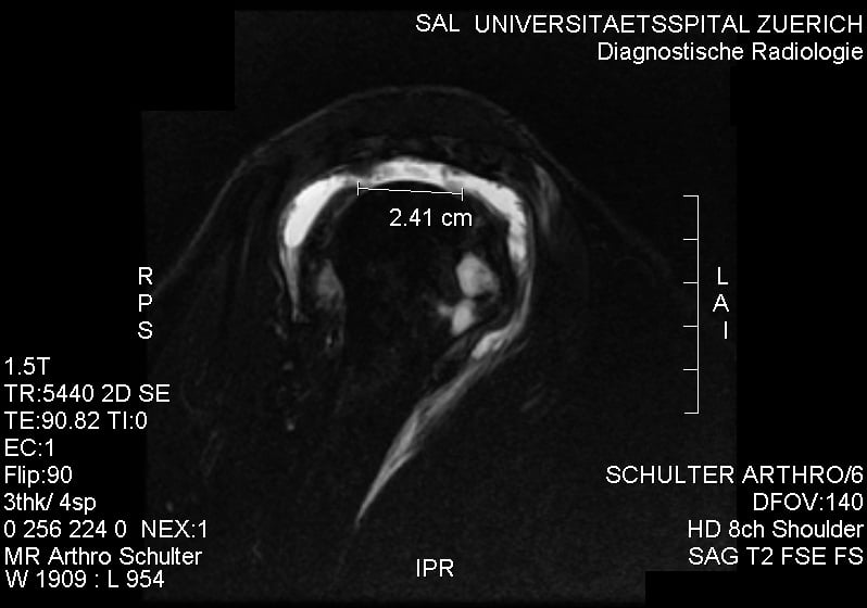 Coronal fat-saturated MR arthrogram showing a complete supraspinatus tear with a measured gap