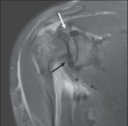 Coronal MRI of the shoulder with arrows marking rotator cuff stump interposition