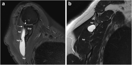 Two-panel MRI showing a well-defined intramuscular cyst within the infraspinatus muscle