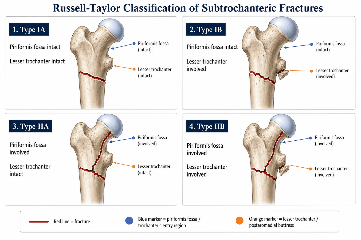 Russell-Taylor Classification of Subtrochanteric Fractures