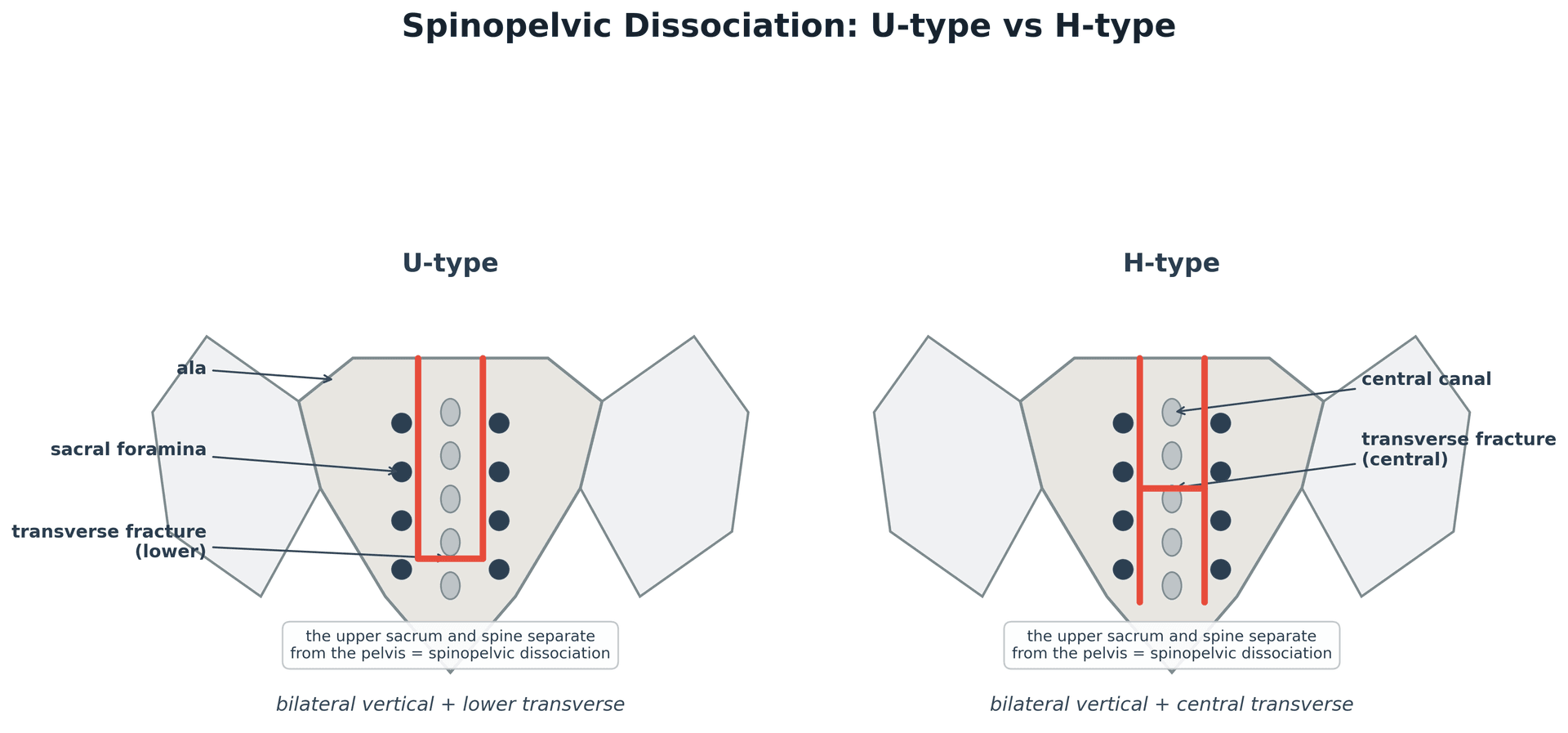 Posterior sacrum diagram comparing U-type and H-type spinopelvic dissociation fracture patterns