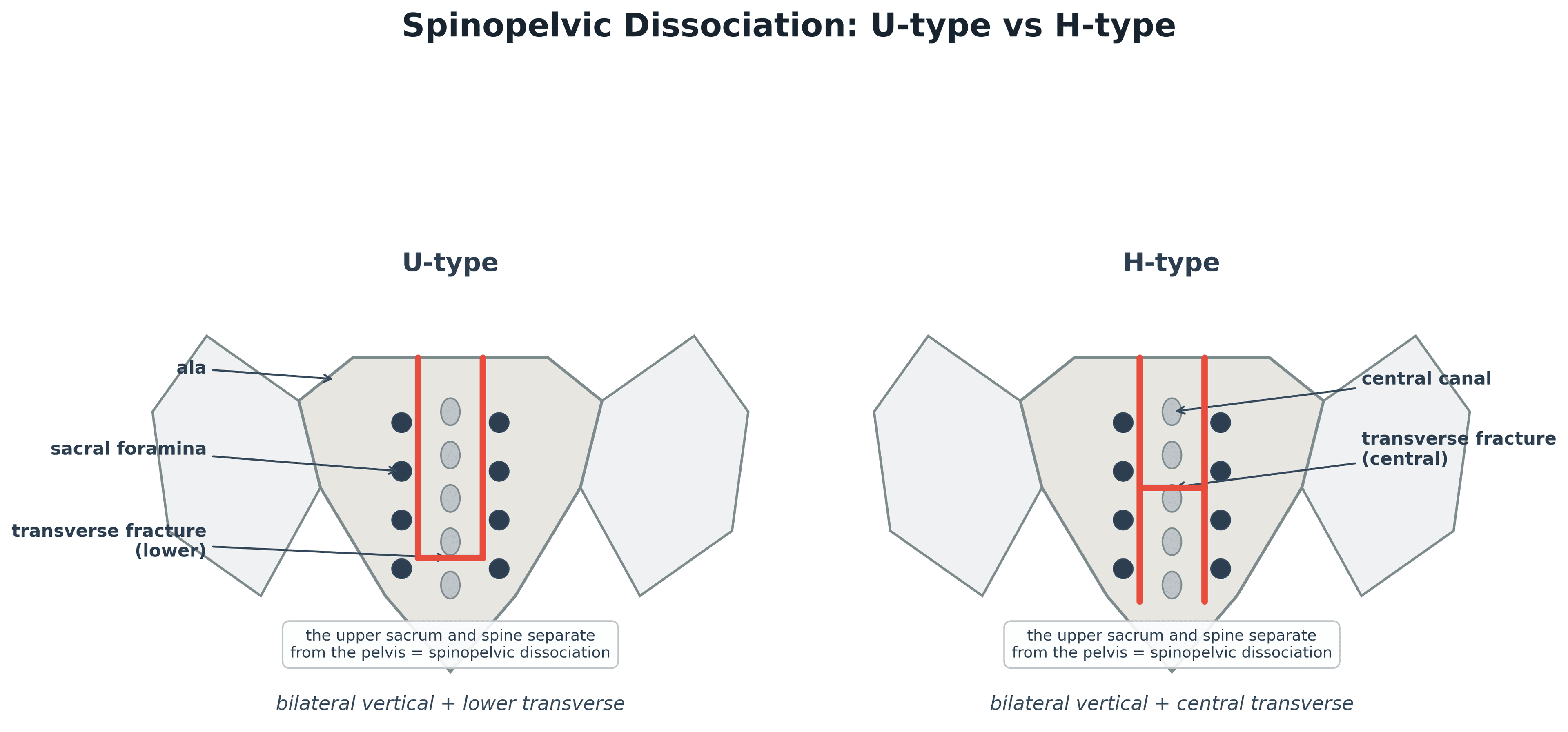 Posterior sacrum diagram comparing U-type and H-type spinopelvic dissociation fracture patterns
